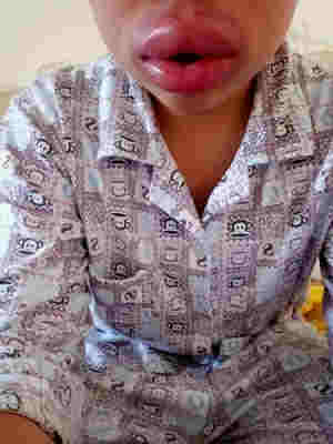 抽電子煙舌尖腫了怎么辦