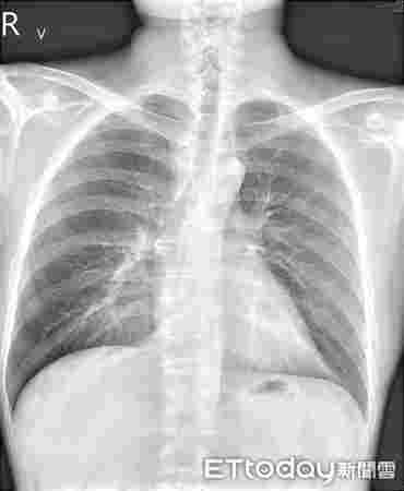 臺灣媒體讓電子霧化煙看起來比吸煙更危險 